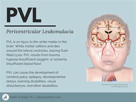 pvl tickets|what is periventricular leukomalacia.
